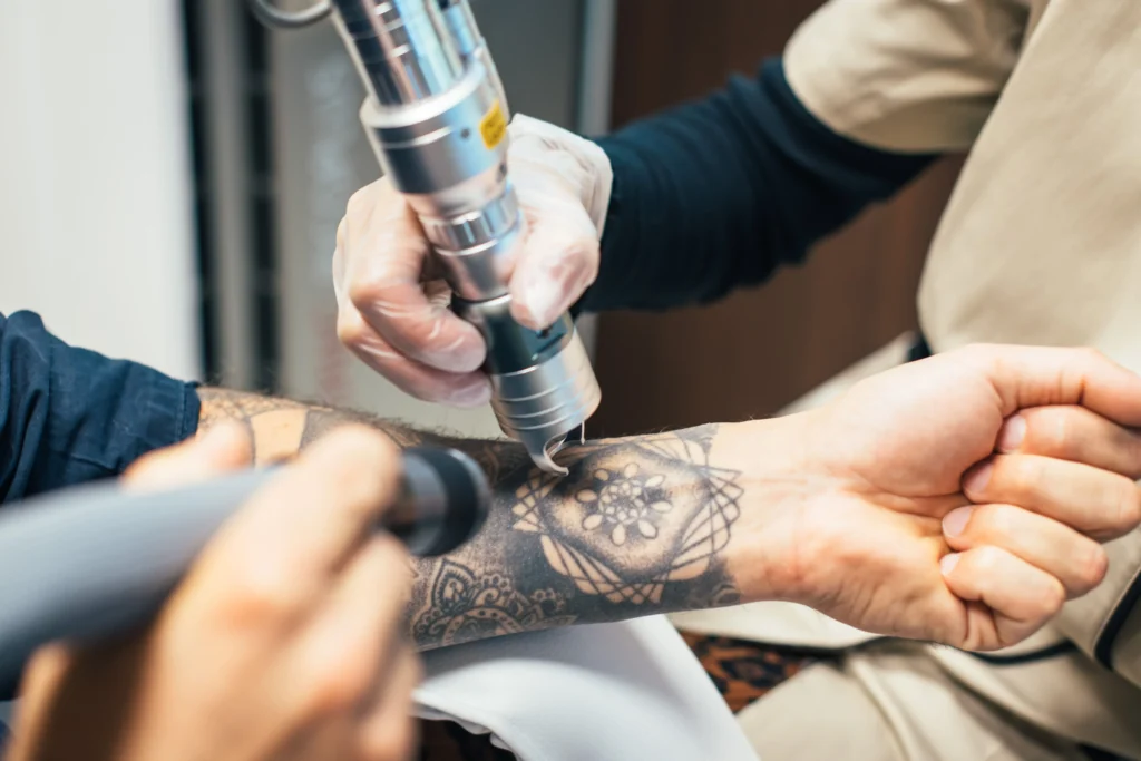 Détatouage Laser Origine Studio